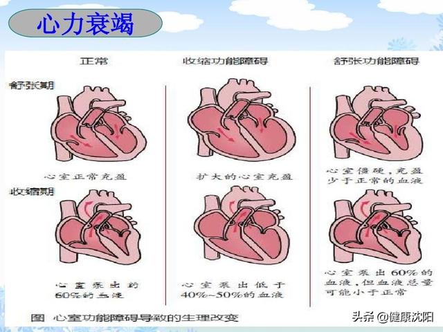 健康科普堂 | 心力衰竭是一种怎样的疾病